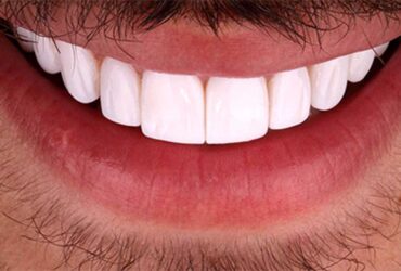 لمینت دندان