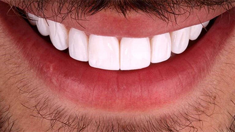 لمینت دندان